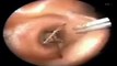 Doctors remove GIANT Insect from Man's Ear after he come with Tickling Sensation in India
