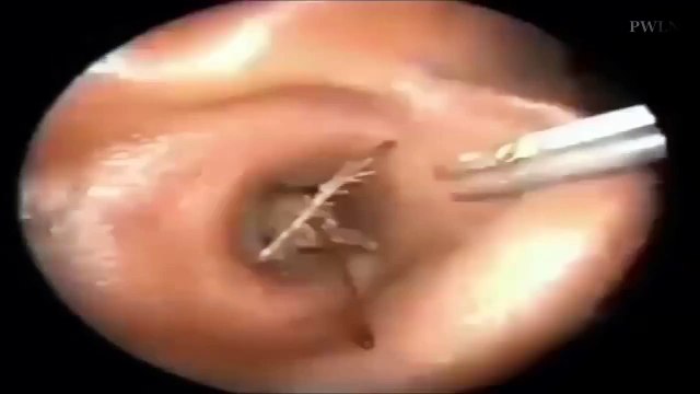 Doctors remove GIANT Insect from Man's Ear after he come with Tickling Sensation in India