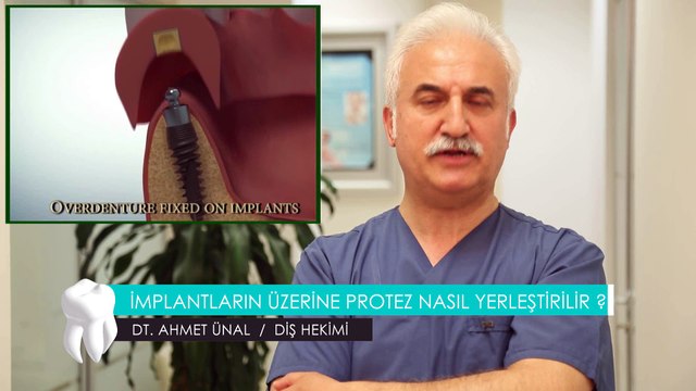 DT. AHMET ÜNAL / DİŞ HEKİMİ - İMPLANTLARIN ÜZERİNE PROTEZ YERLEŞTİRİLİR Mİ ?