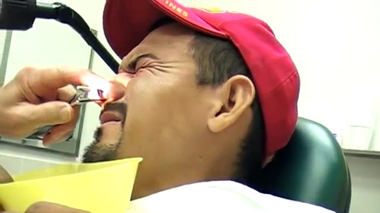 Removing nose packing