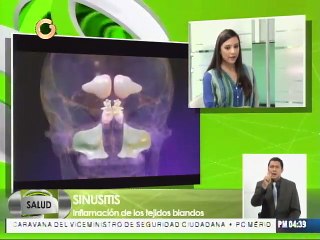 Estos son los síntomas de la sinusitis