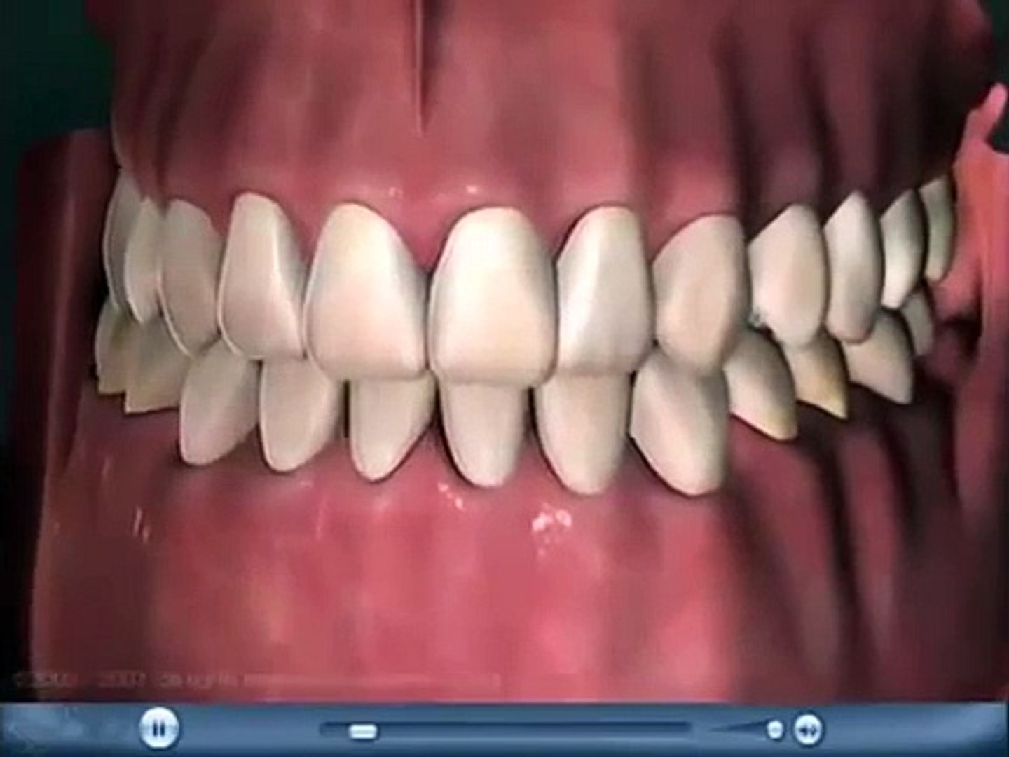 Educational Dental Videos  Tooth Decay