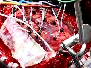 Live Webcast: Brain Surgery -Right Frontal Craniotomy