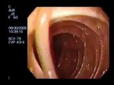 Extracción de un gusano intestinal con la Colonoscopia | Parásitos Intestinales | Cancer.Vg