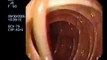 Extracción de un gusano intestinal con la Colonoscopia | Parásitos Intestinales | Cancer.Vg