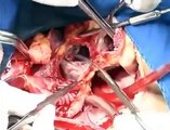 Heart Transplant Surgery (Cardiac Transplant) | A Complete Video