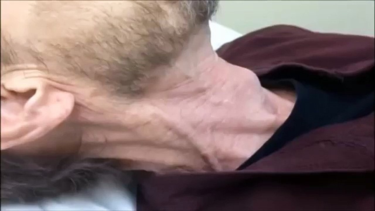 Jugular Venous Distention - JVD