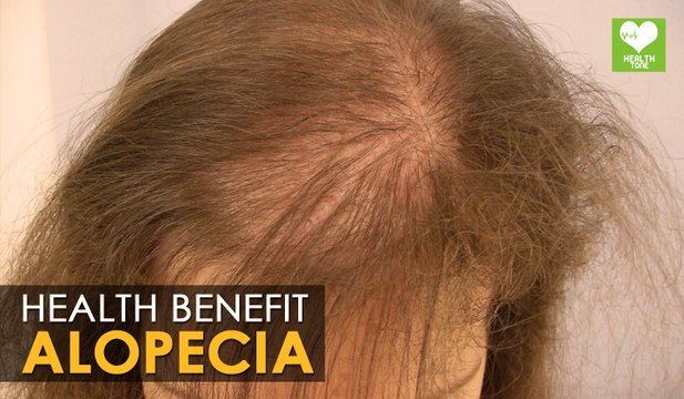 Alopecia Areata (Hair Loss) - Home Remedies | Health Tips