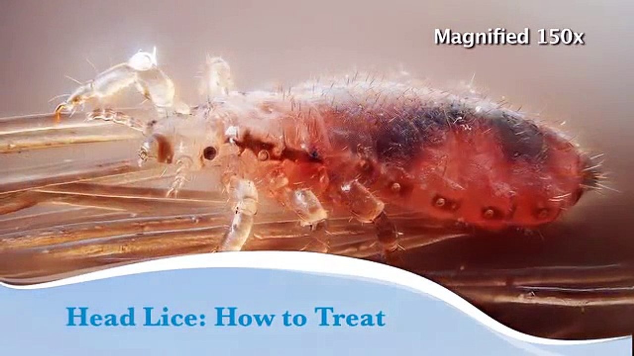 Head lice: How to treat