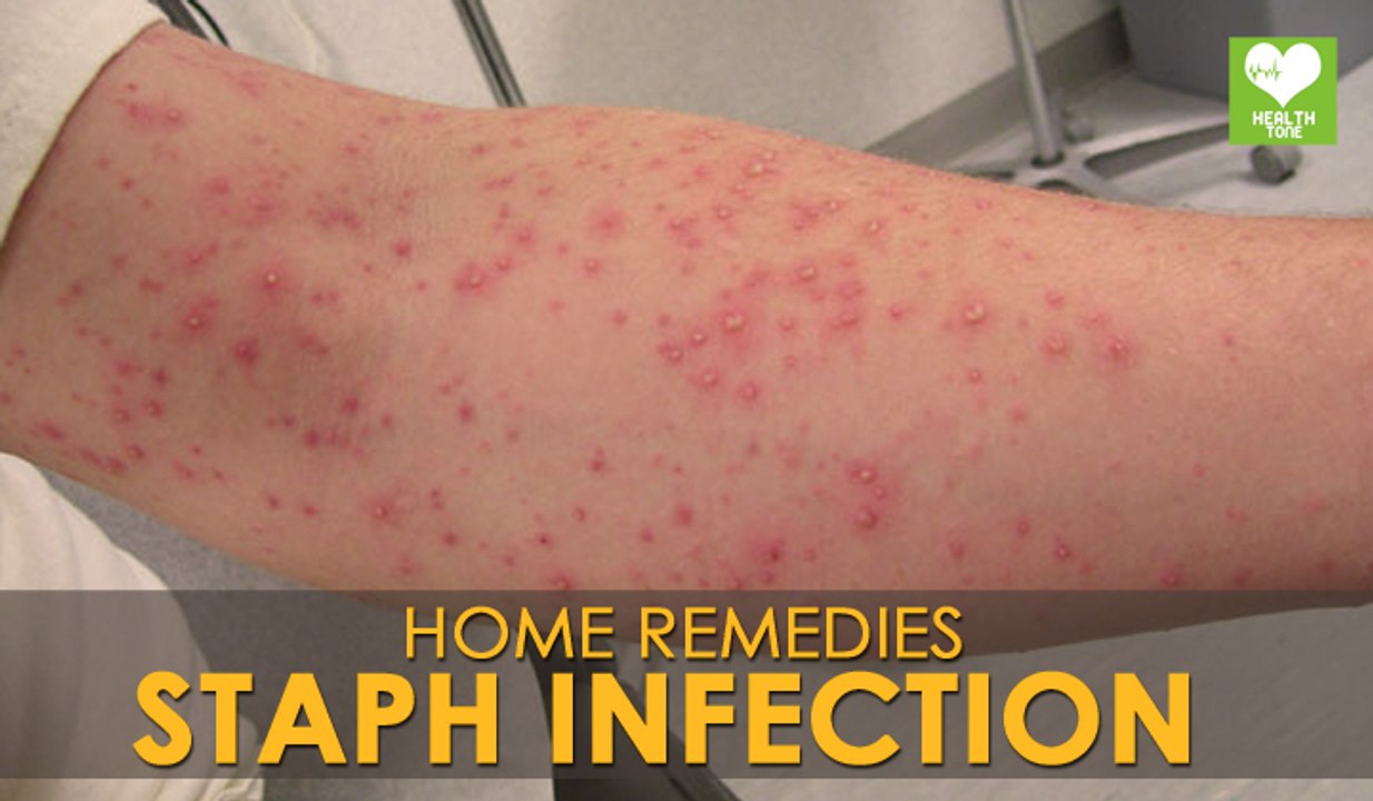 Staph Infection Treatment - Home Remedies | Health Tips