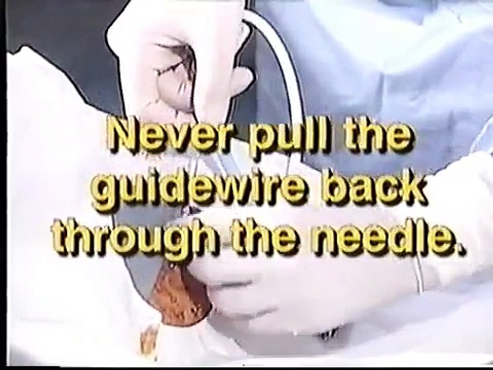 Hemodialysis catheter insertion by Quinton