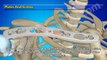 Broken Collarbone Surgery 3D Video (Plates & Screws, Pins, Bone Graft & Fixation)