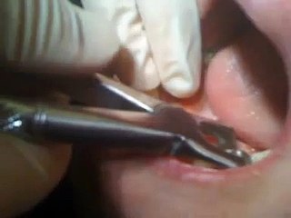 Extraction dentaire, Extraction dent, Dentiste (www.les-dents.com).mov