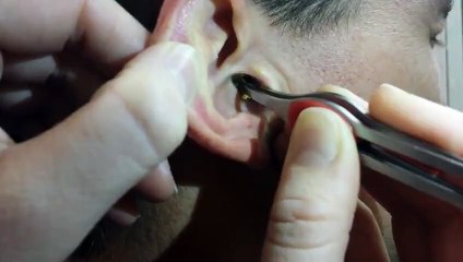 Ce type se fait enléver le plus gros bouchon d'oreille que j'ai jamais vu ! Immonde !