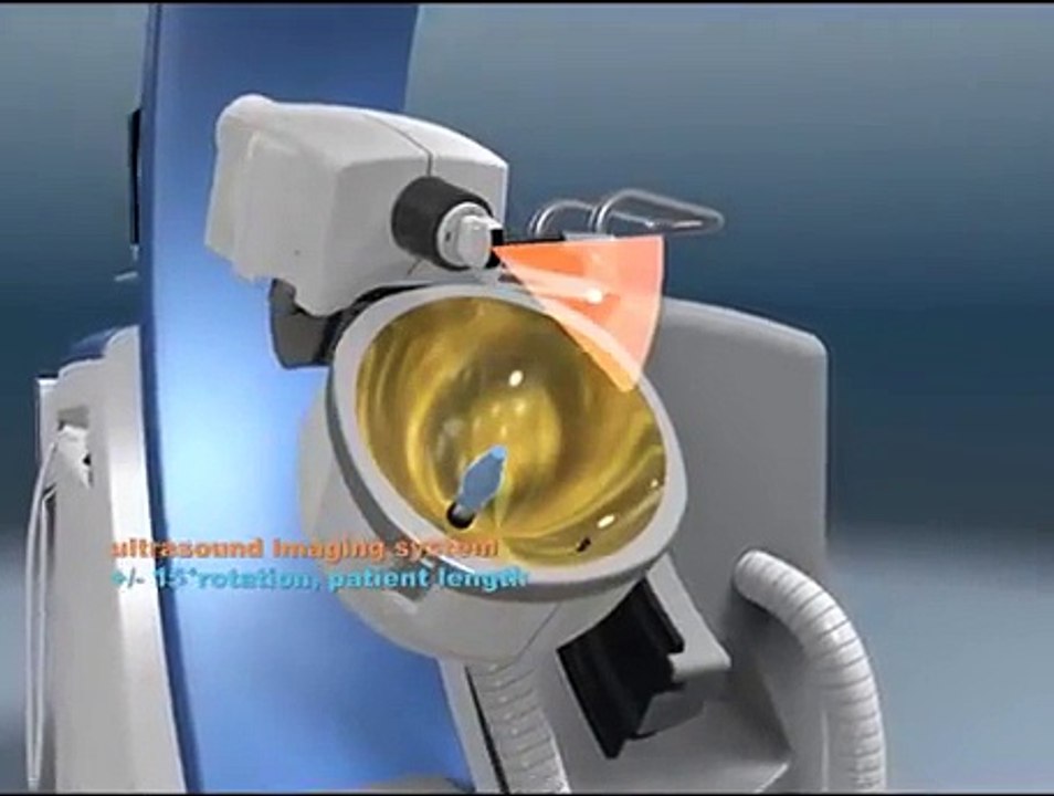 New generation extracorporeal shock wave lithotripsy system for kidney