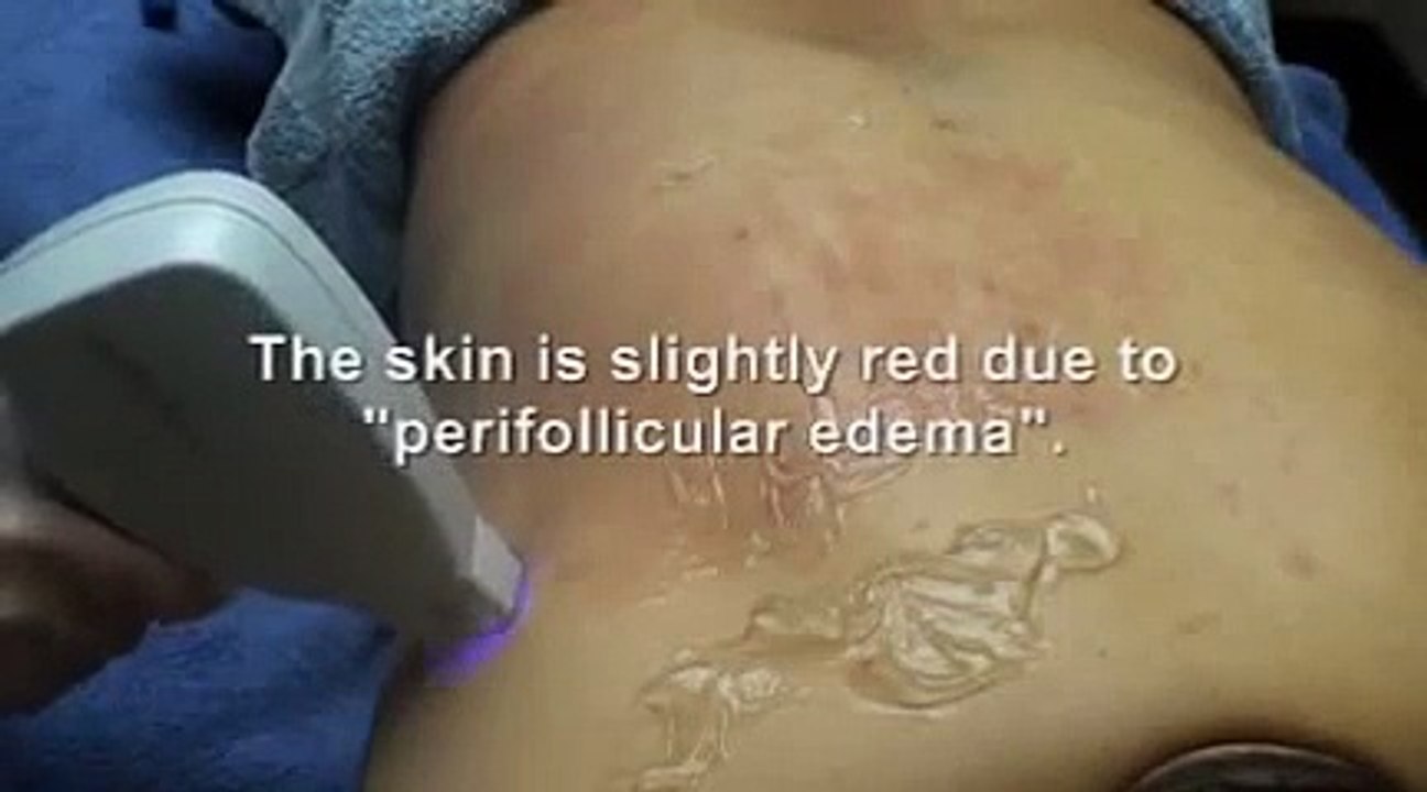 Laser hair removal - middle eastern patient - hairy back