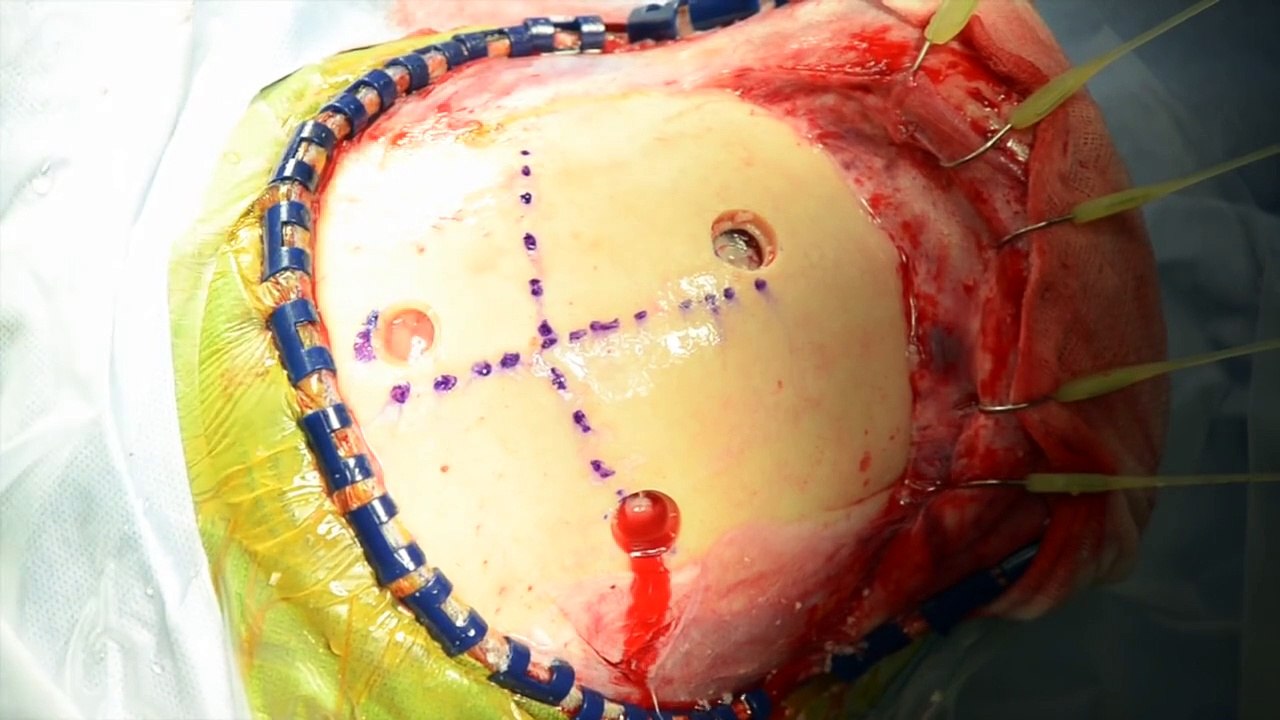 Parasagittal Craniotomy   iPad