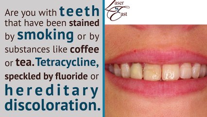 Professional Teeth whitening NYC Promo - CALL 631-850-3557