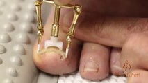 Ingrown nail correction block seems unbelievably painful