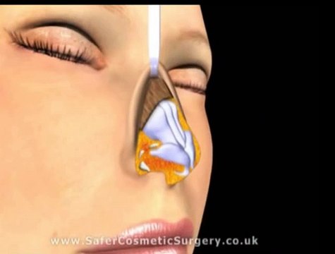 Nâng mũi bọc sụn không đau