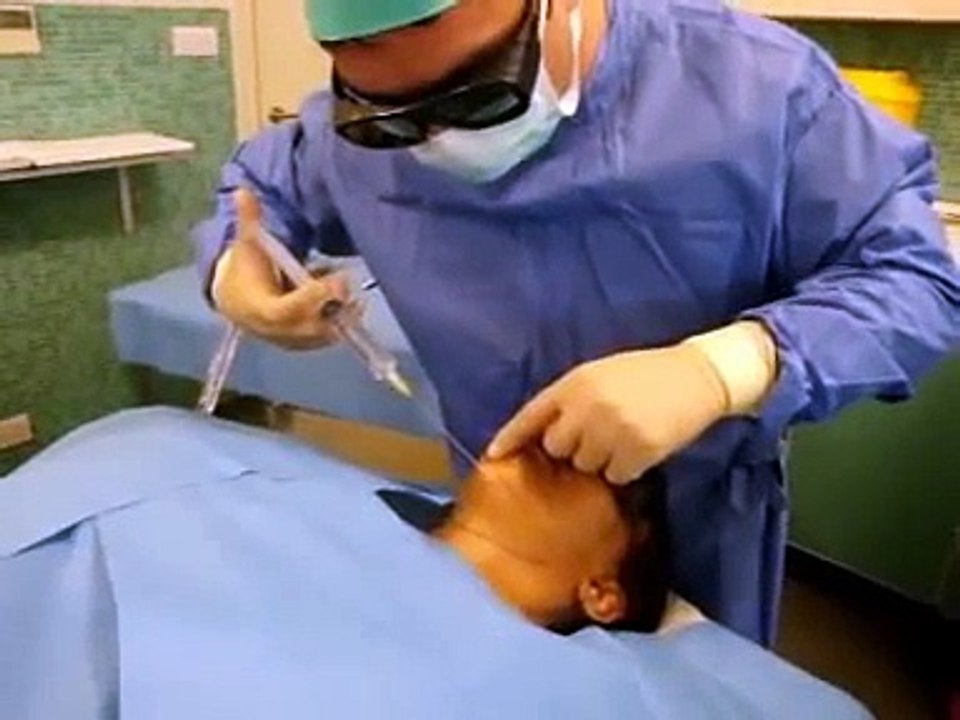Smartlipo Laser Liposuction for Chin  By Dr Ayham Al-Ayoubi