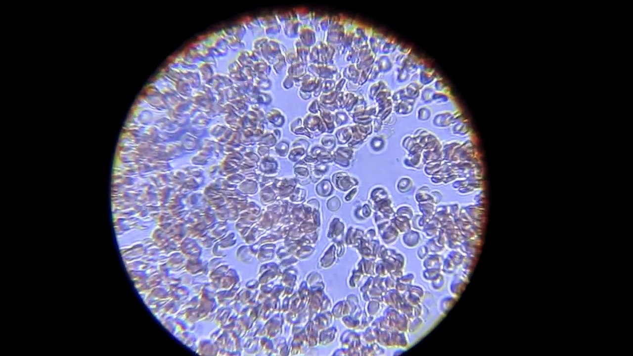 Mixing blood with alcohol under microscope