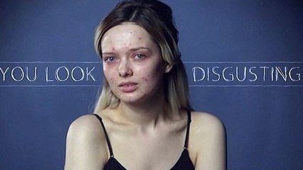 Vea cómo respondió una youtuber al bullying que sufrió por su acné