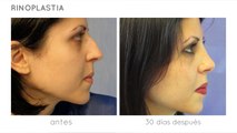 Cirugía de Nariz antes y después | Testimonio de Laura
