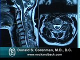 How to Read a MRI of Cervical Stenosis with Spinal Cord Injury | Spine Surgeon in Colorado