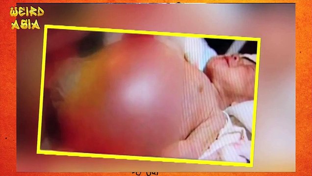 2 Year Old Gives Birth To Own Twin Shocking