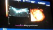 Doppler ultrasound @ 26 weeks/ Υπέρηχος Doppler 26 εβδομάδες