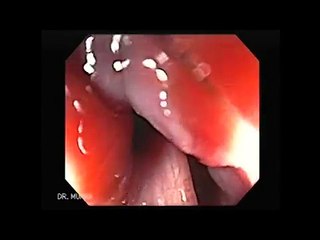 Colonoscopy of a Rectal Cancer