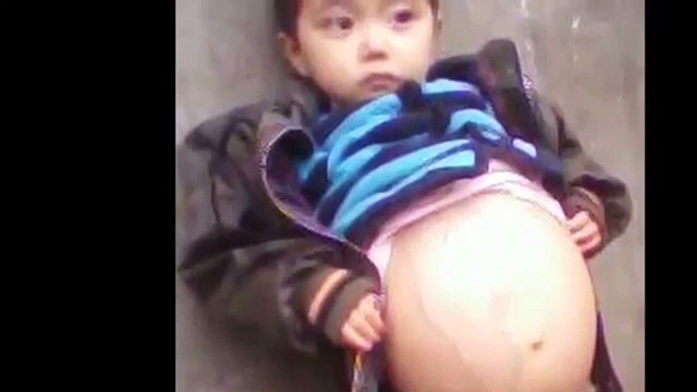 Hu Yunxing, 4 Year Old Girl Who Looks 9 Months Pregnant