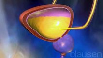 What is Bladder cancer? , Treatment, Medical animation