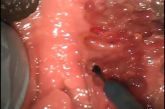 Verrugas vaginales cirugia