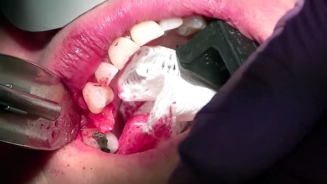 Extraction with Immediate Dental implant placement