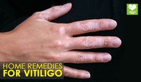 Home Remedies For Vitiligo | Health Tips