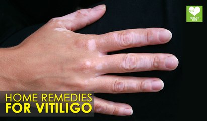 Home Remedies For Vitiligo | Health Tips