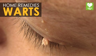 Warts Removal - Home Remedies | Health Tips