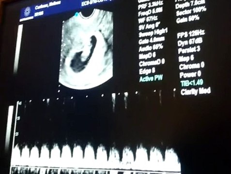 8 Haftalık Gebelik Bebek Ultrason Görüntüsü
