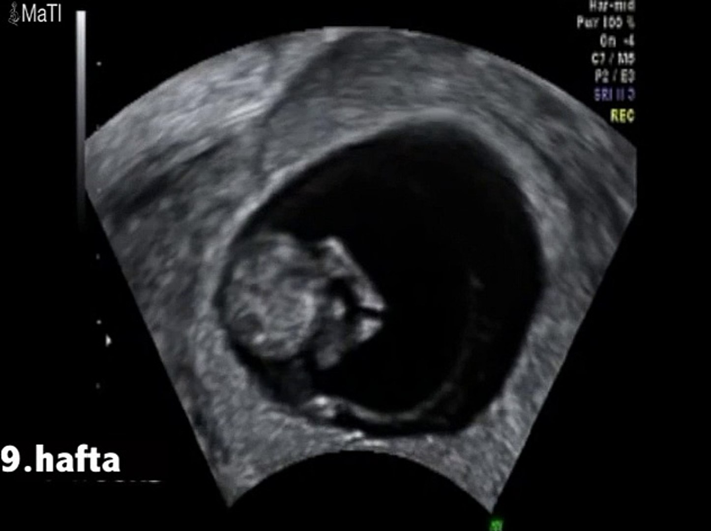 9 Haftalık Gebelik Bebek Ultrason Görüntüsü - Dailymotion Video