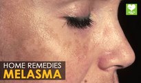 Melasma Treatment (Cure) - Home Remedies | Health Tips