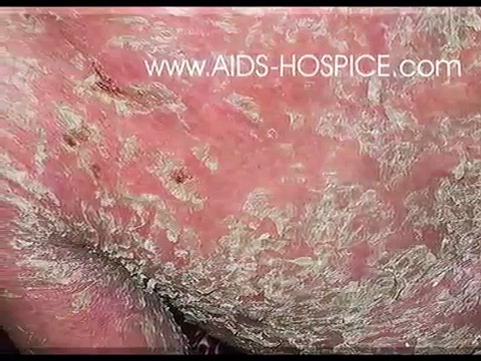 閲覧注意 エイズ患者の画像が震えるwww 動画 Dailymotion