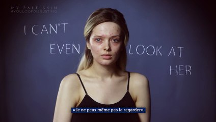 Moquée pour son acné, elle répond sur les réseaux sociaux