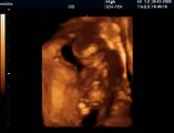 14 Haftalık Gebelik Bebek Ultrason Görüntüsü