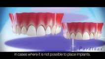 Dental Implants Vs. Dental bridge - Comparision ©