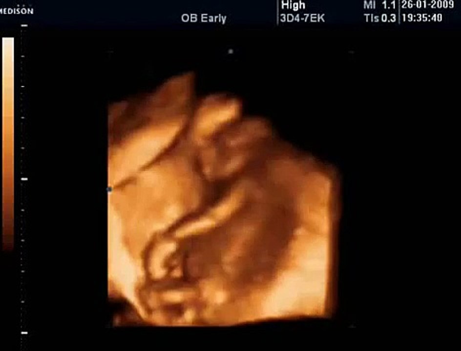 16 Haftalık Gebelik Bebek Ultrason Görüntüsü