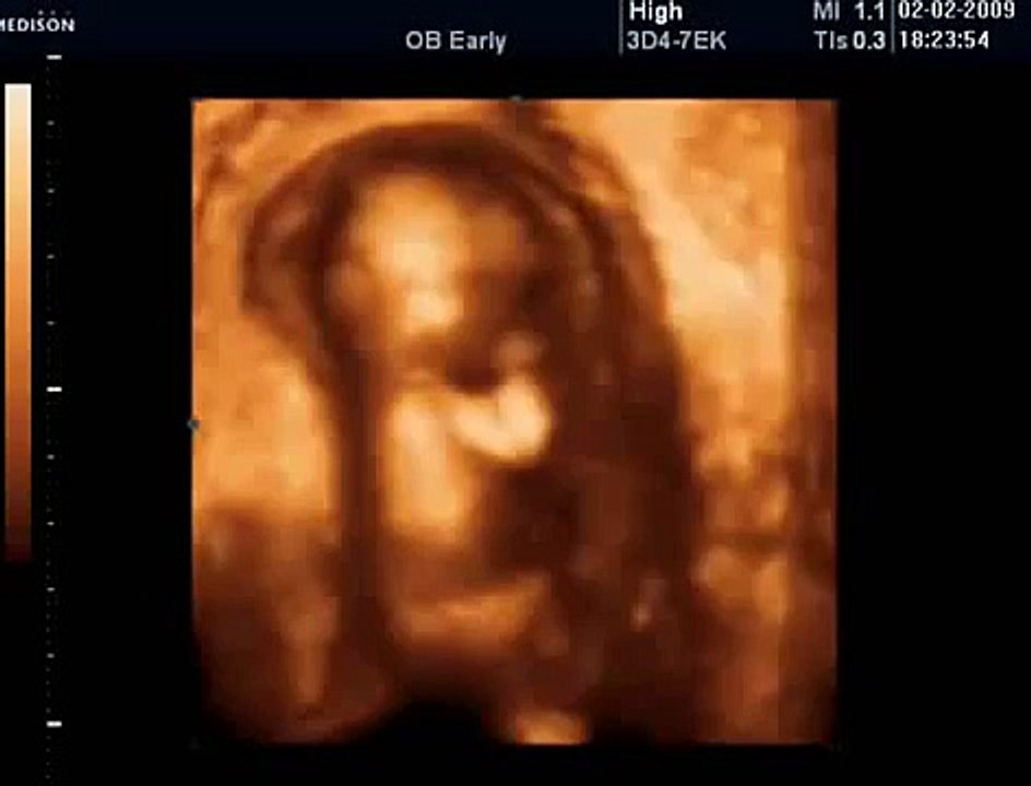 18 Haftalık Gebelik Bebek Ultrason Görüntüsü