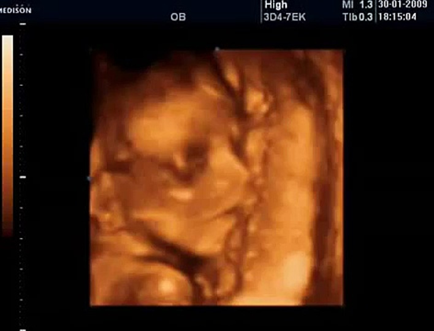 21 Haftalık Gebelik Bebek Ultrason Görüntüsü - Dailymotion Video