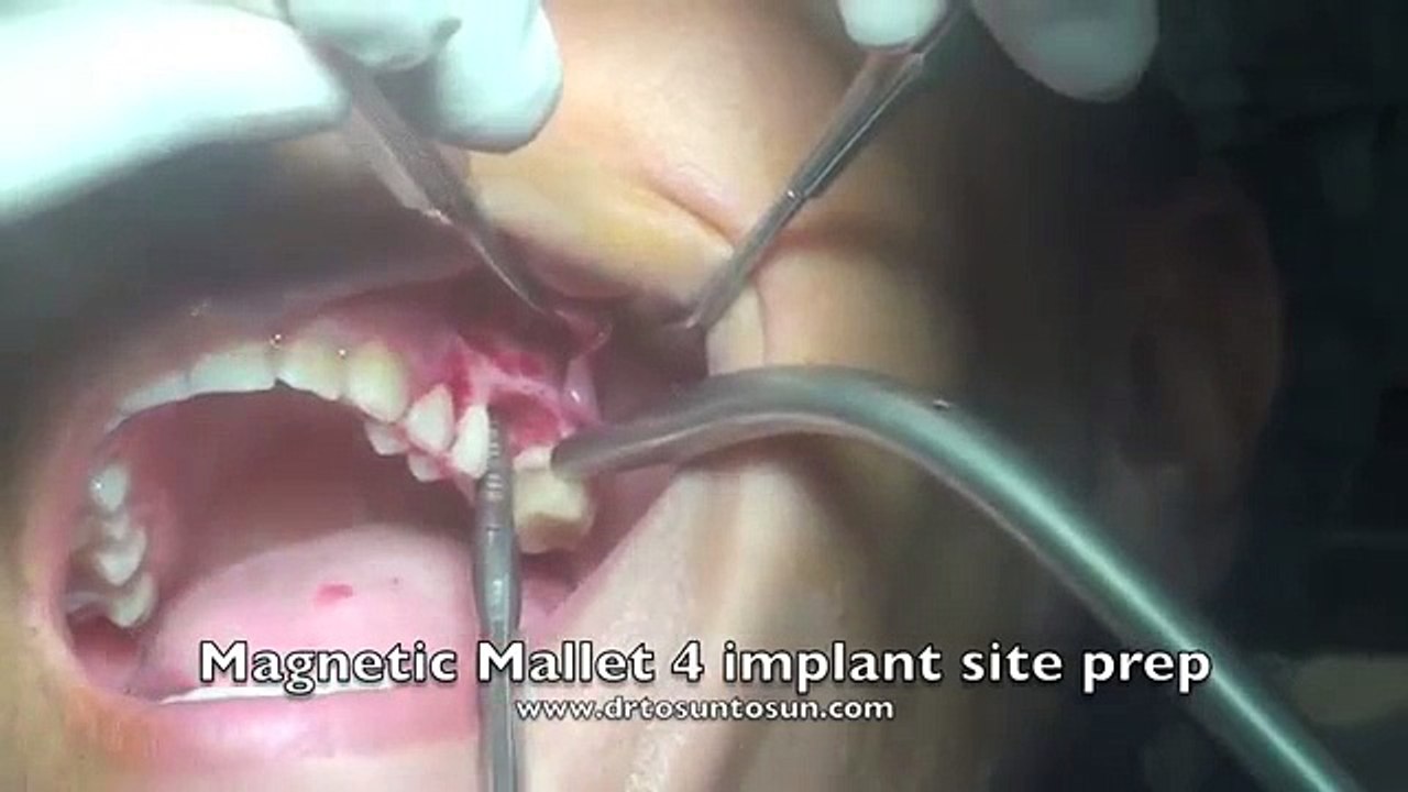 Mallet for simultaneous sinus lift by PRF and implant